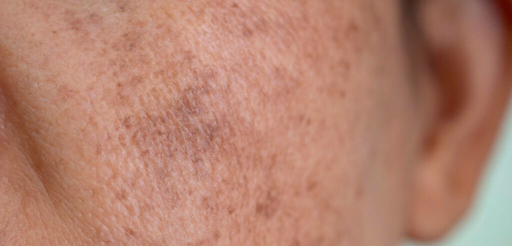 Hyperpigmentation After 35: Why Dark Spots Get Worse, and How to Fade Them Naturally